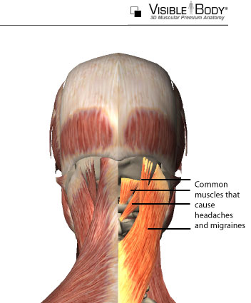 Headaches treatment with low force adjustments and Active ...